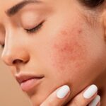 Tips for Treating Dry Facial Skin